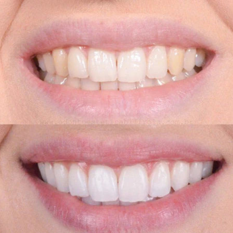 Quick Teeth Whitening for a Radiant Smile