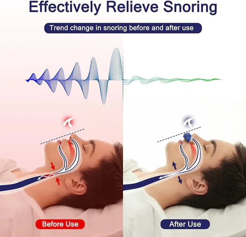 Micro CPAP Sleep Apnea Machine for Travel & Anti-Snoring - CPAP Alternative