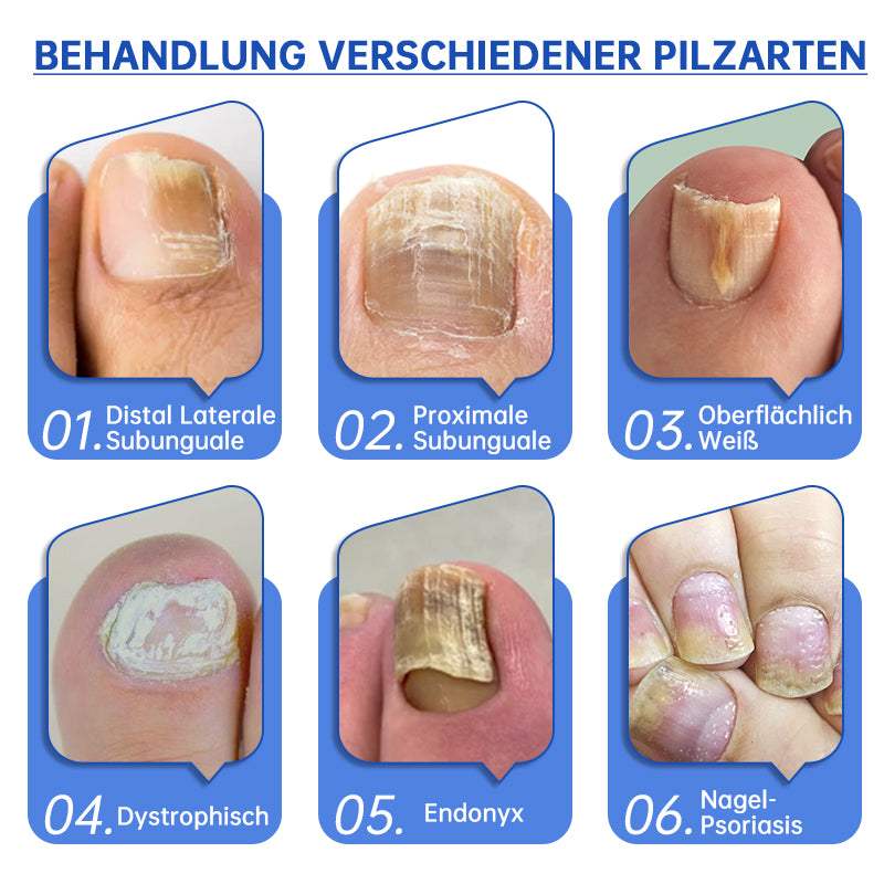 NailCure™ - Nail Fungus Laser Treatment Solution (50% DISCOUNT)