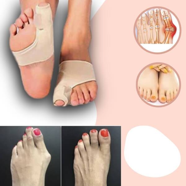 Orthotics for Hallux Valgus