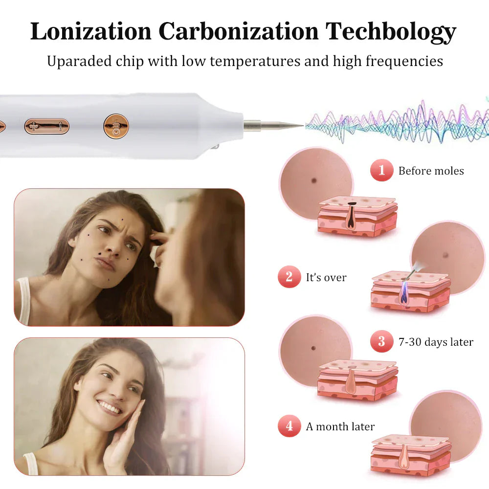 Plasma Pen Skin Tag Remover